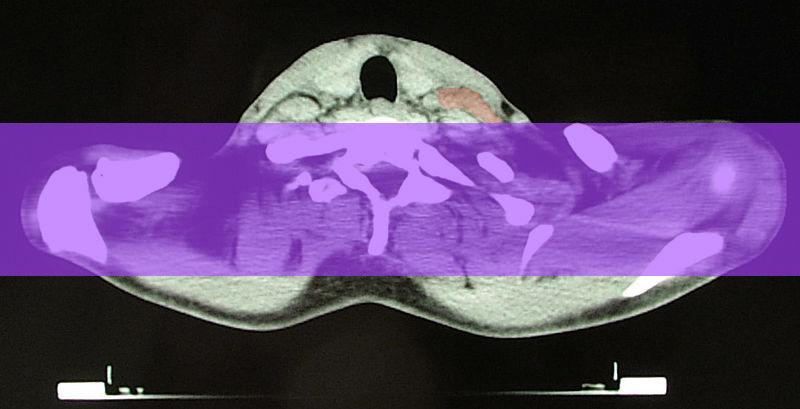 Hodgkin-Lymphom überlebt – Herzerkrankungen als Spätschäden