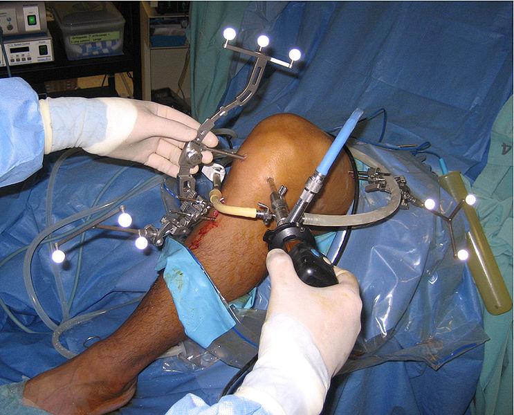 Bei Kniearthrose bringt Arthroskopie wenig