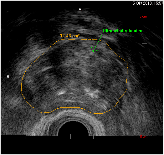 Prostatavergrößerung – Welche operativen Behandlungsoptionen?